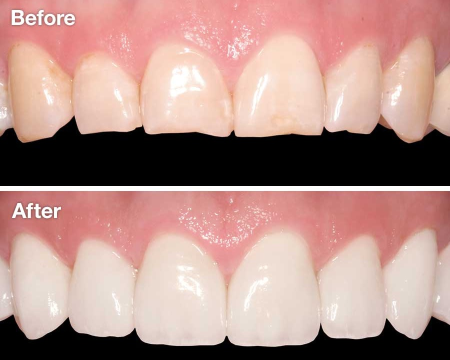 Porcelain Veneers