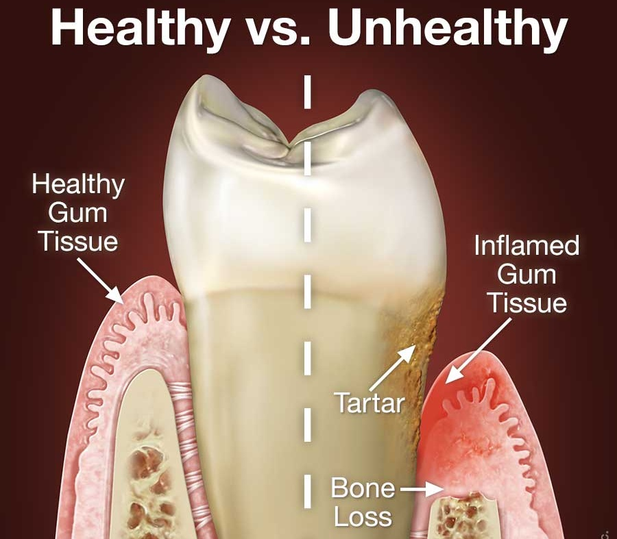 Periodontal (Gum) Disease
