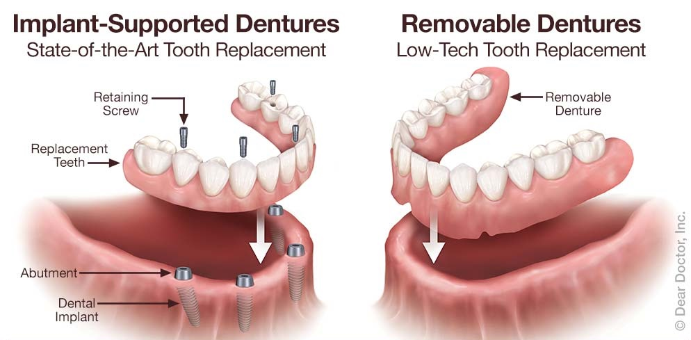 Dentures