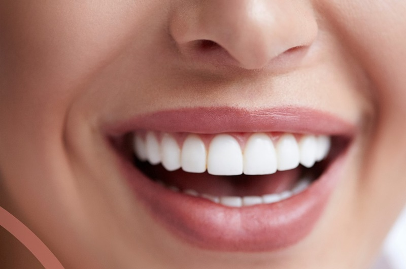 Teeth Whitening