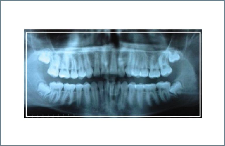 X-rays