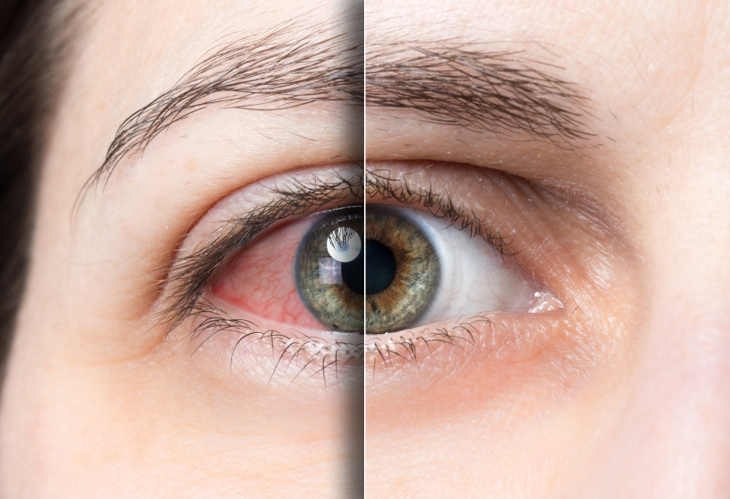 Treatment of Eye Infections