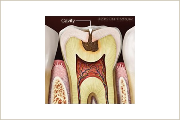 Fillings