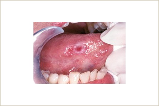 Oral Cancer Screenings