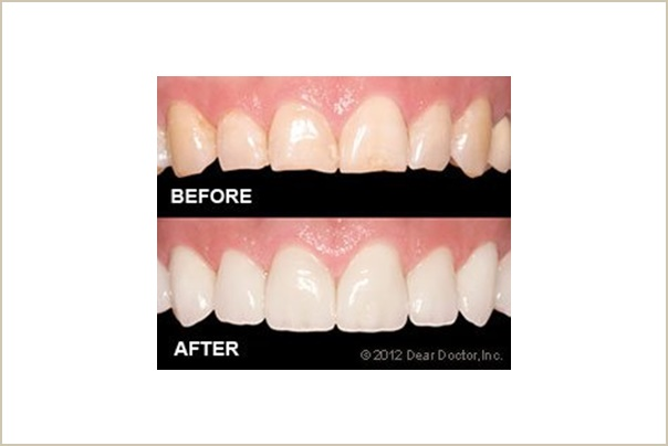 Porcelain Veneers