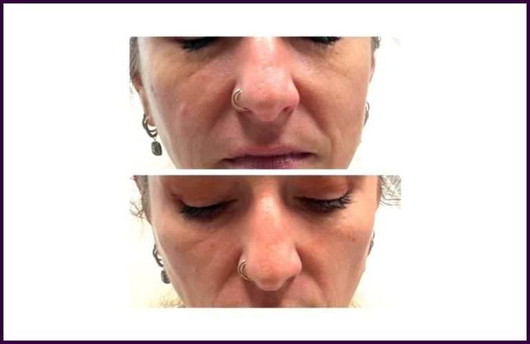 Dermal Fillers