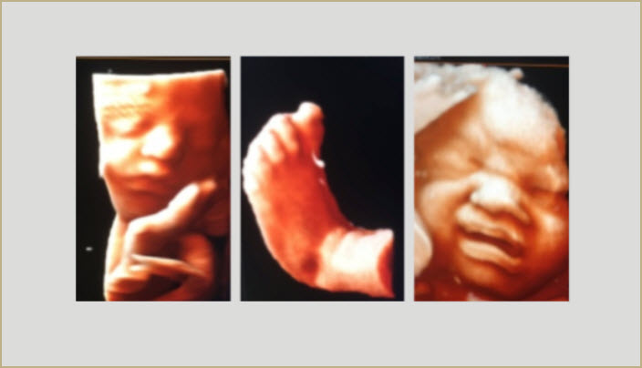2D/3D/4D Ultrasound Scan
