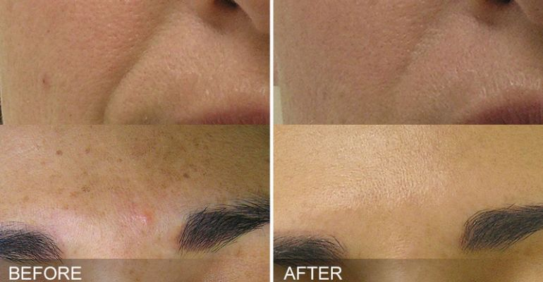 HydraFacial