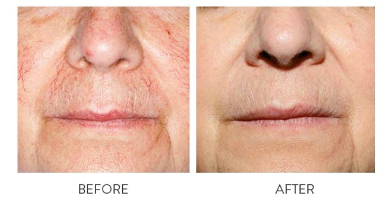 Laser Vein Therapy