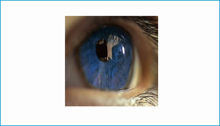 Contact Lenses