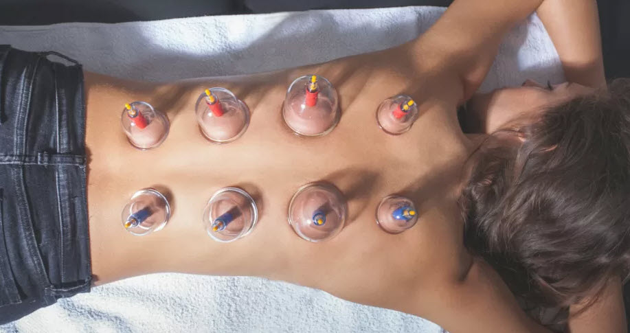 Cupping