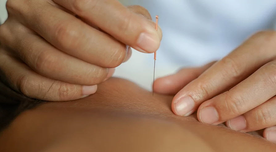 Dry Needling