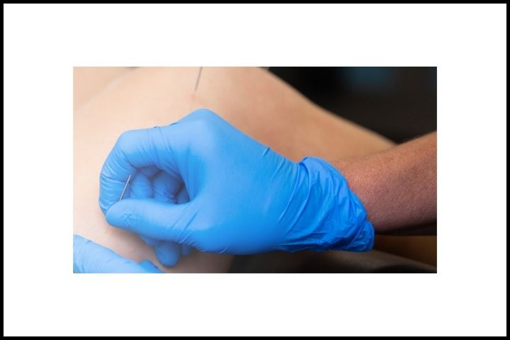 Dry Needling Services