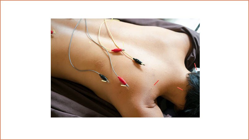 Electro-Acupuncture