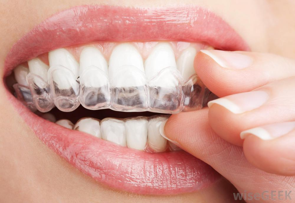 Teeth Whitening