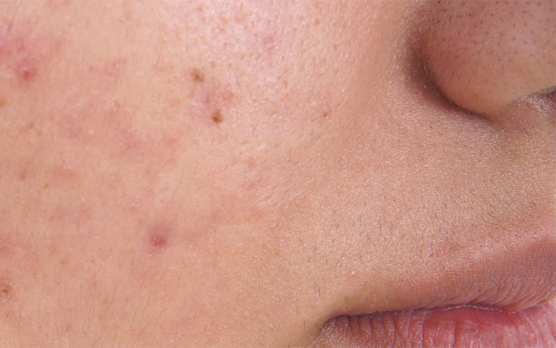 Acne Treatment