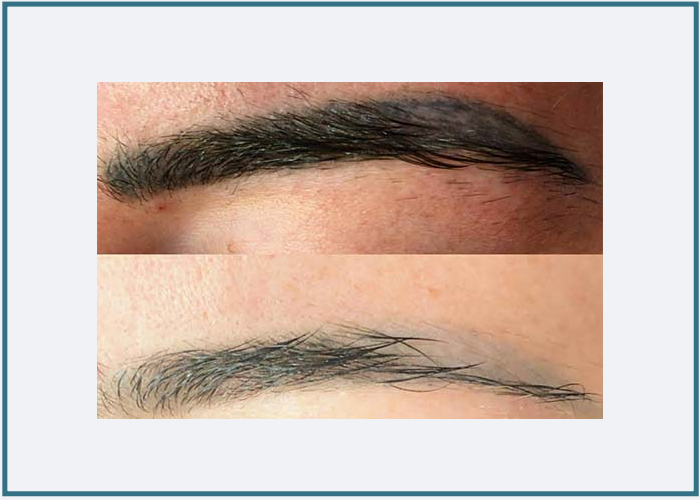 Microblading