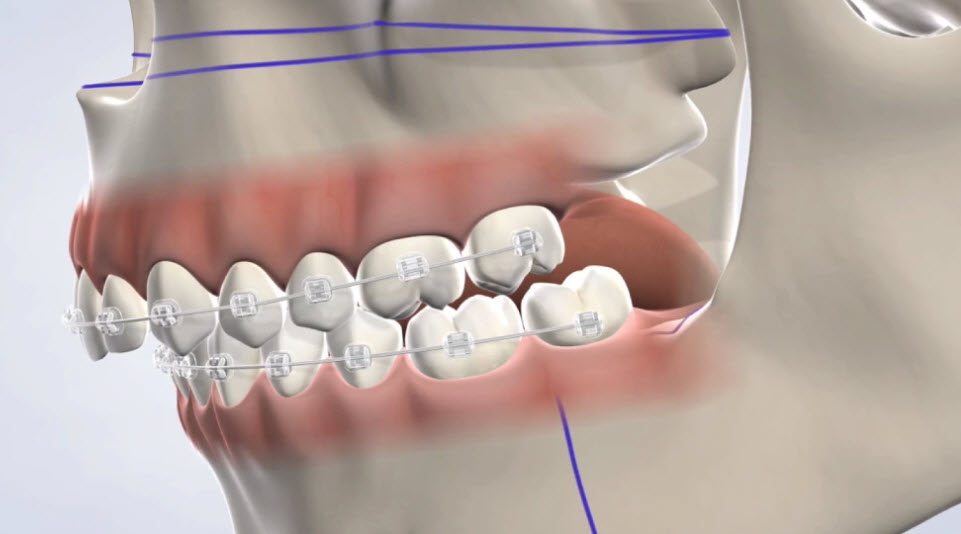  Orthognathic Surgery