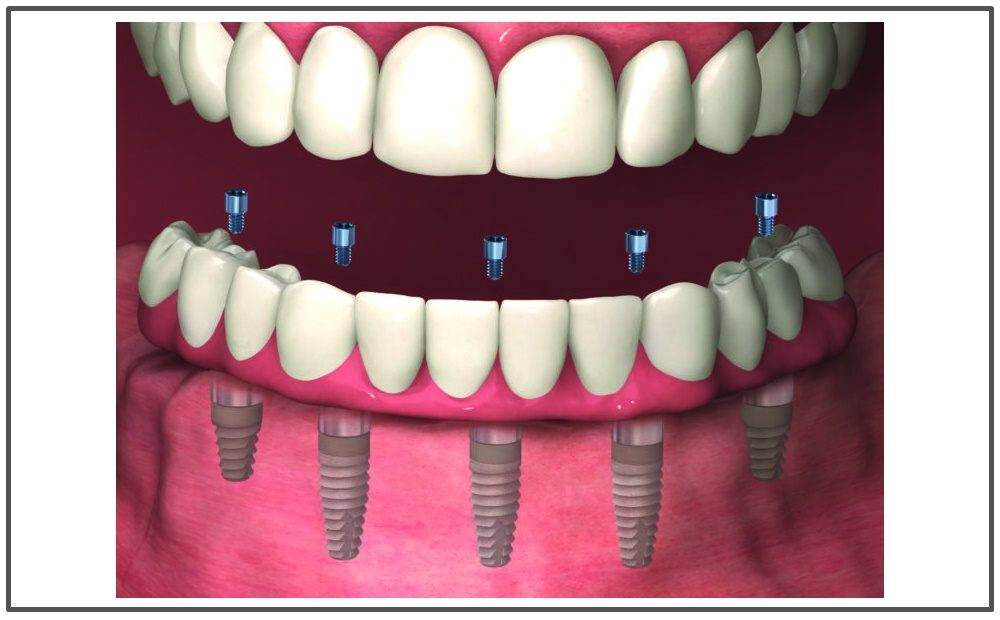 Full-Arch Restoration