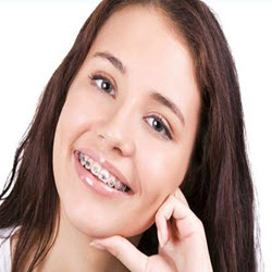 Types Of Braces