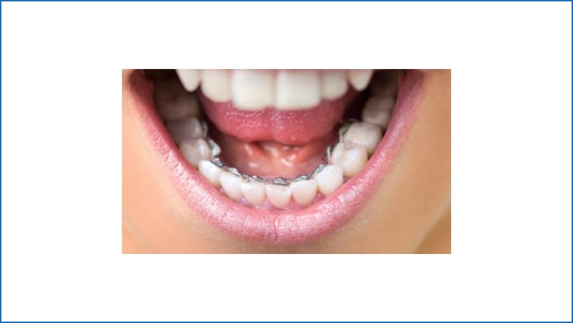 Invisible Braces (Lingual Braces)