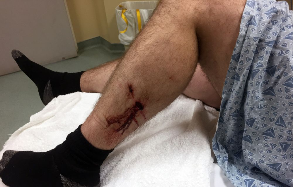 Personal Injury-Dog Bites