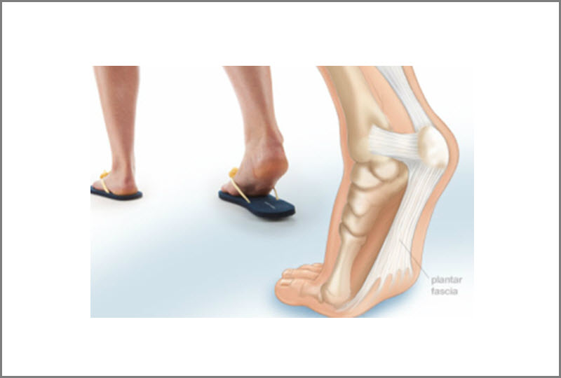 Heel Pain