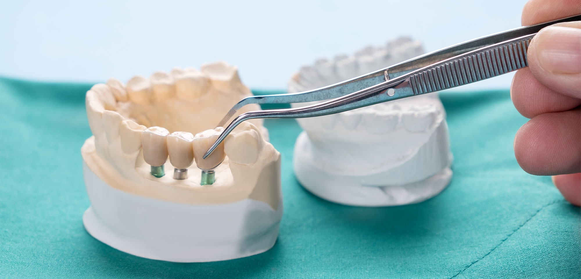 Dental Bridge