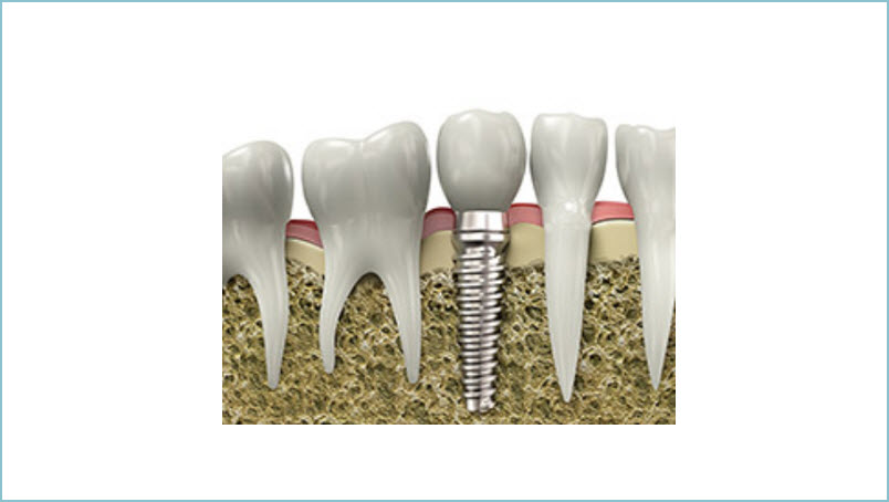  Dental Implants