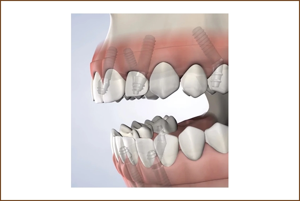 Full-Arch Restoration