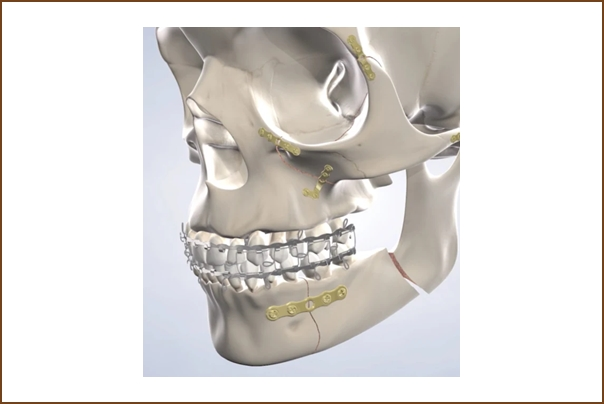 Facial Trauma