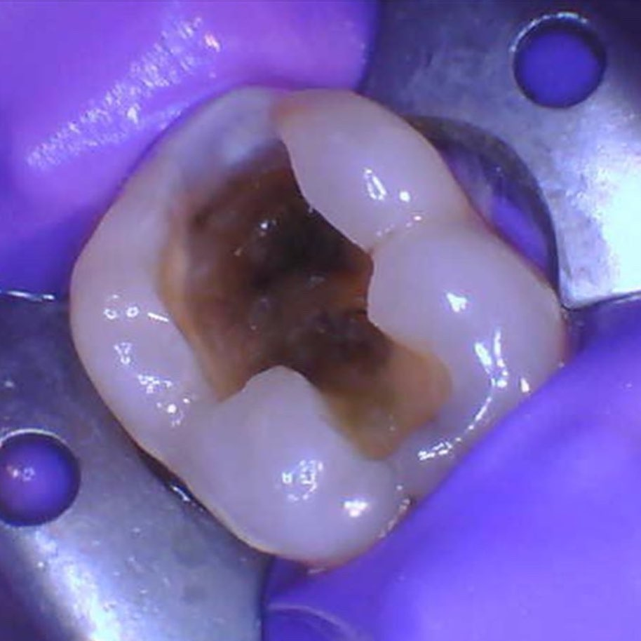 Restorative-Root Canals