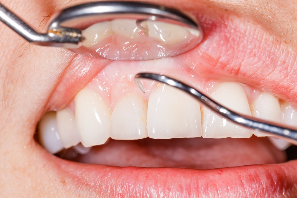 Gum Disease (Periodontal) Treatment