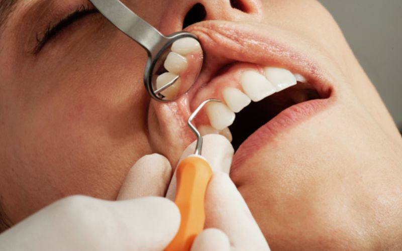 Prophylaxis (Cleaning)