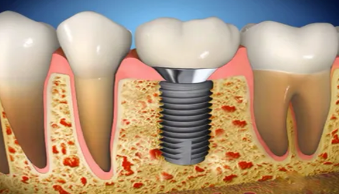 Fixed Partial Dentures (Bridges) and Dental Implant Restorations