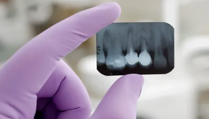 Completely Digital Radiographs