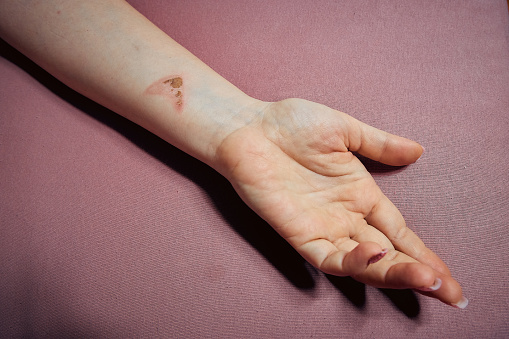 Minor Bruises and Burns