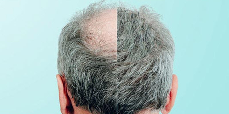 Hair Regrowth