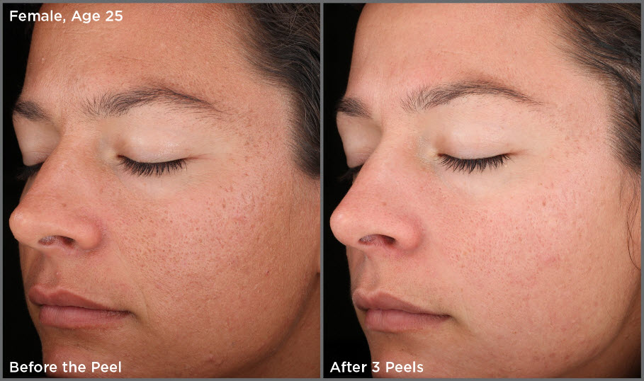 Chemical Dermal Peel