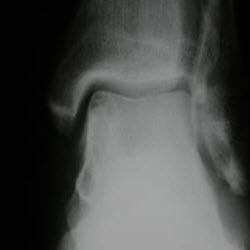 Ankle Sprain Articles