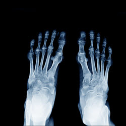 Bunion Pain