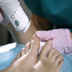 Laser Nail Therapy