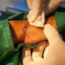 Suture Repair