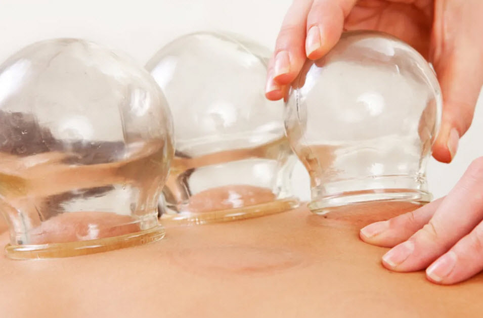 Cupping Therapy