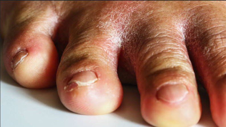 Painful Fungal Nails
