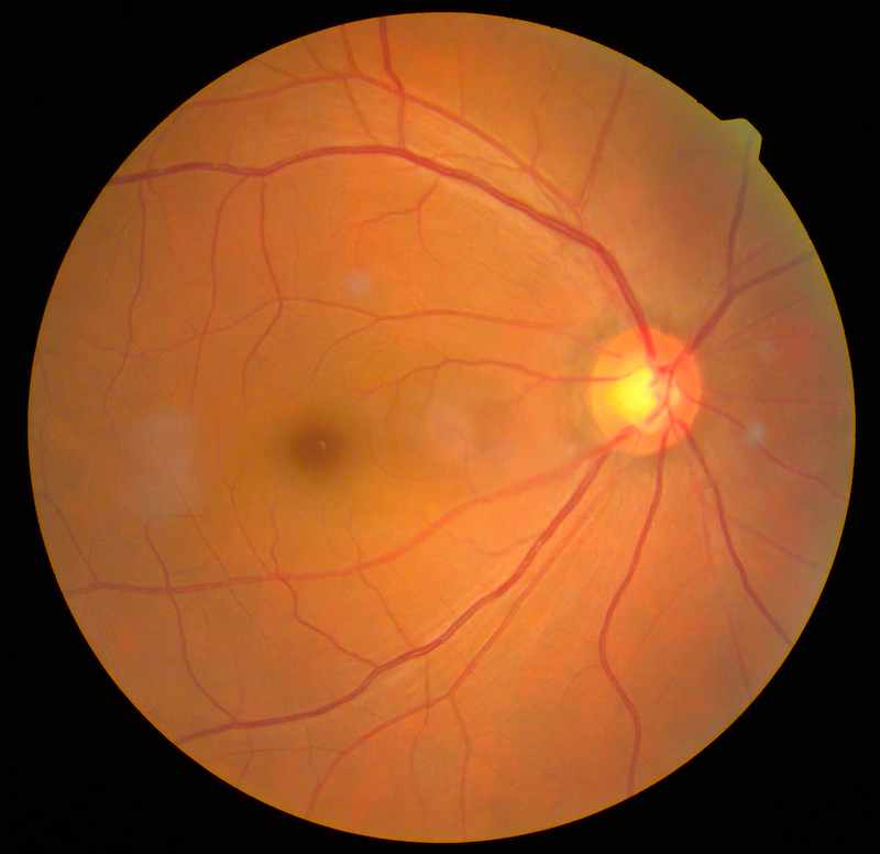 Retinal Photography