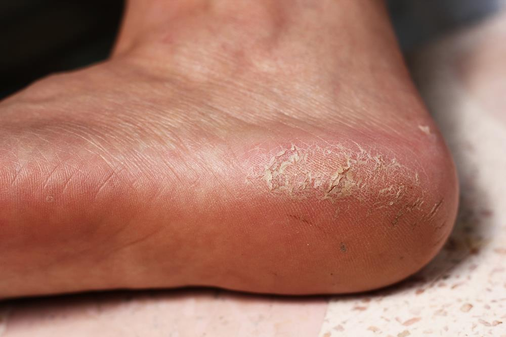 Calluses Condition