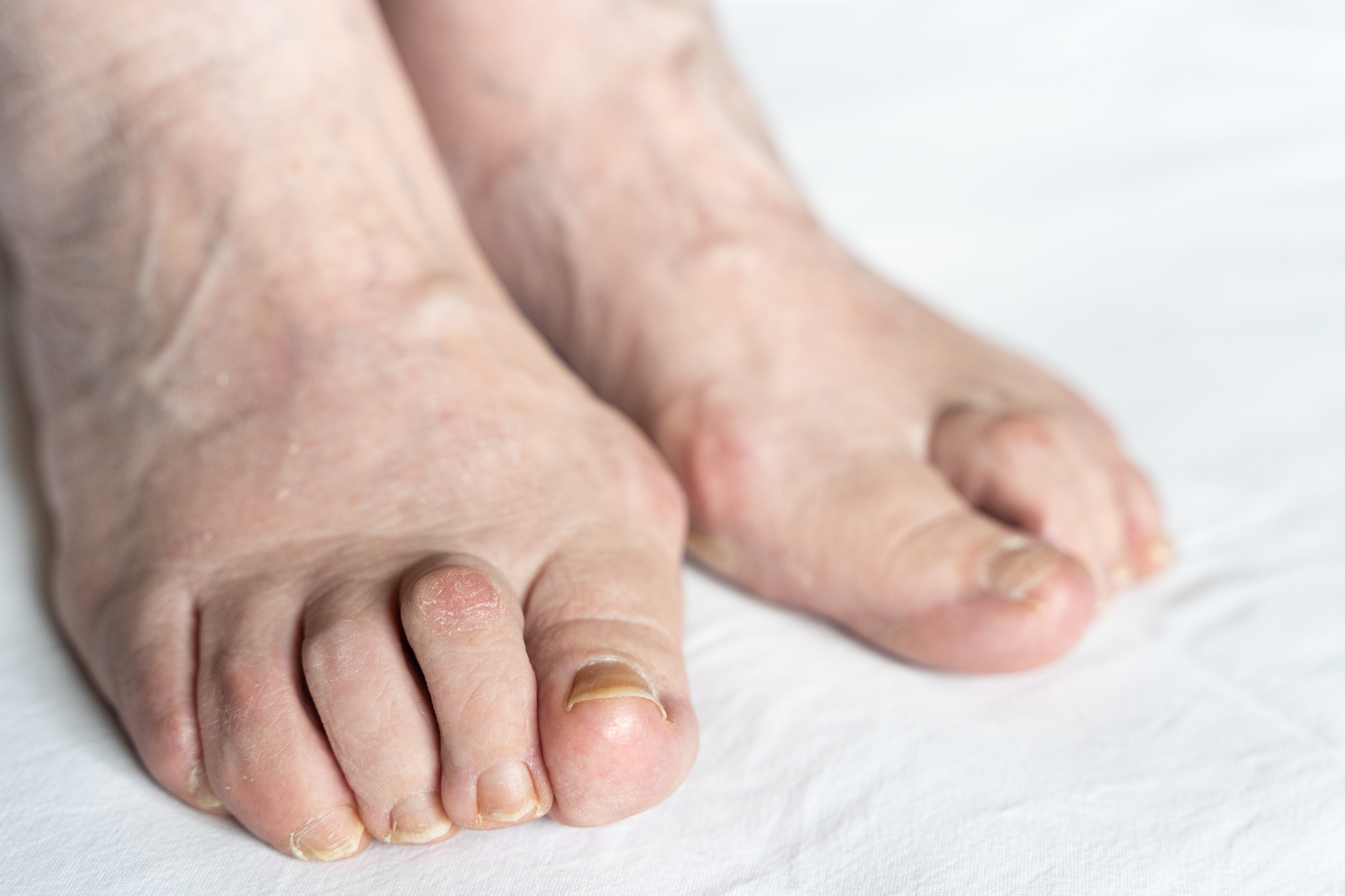 Hammertoes