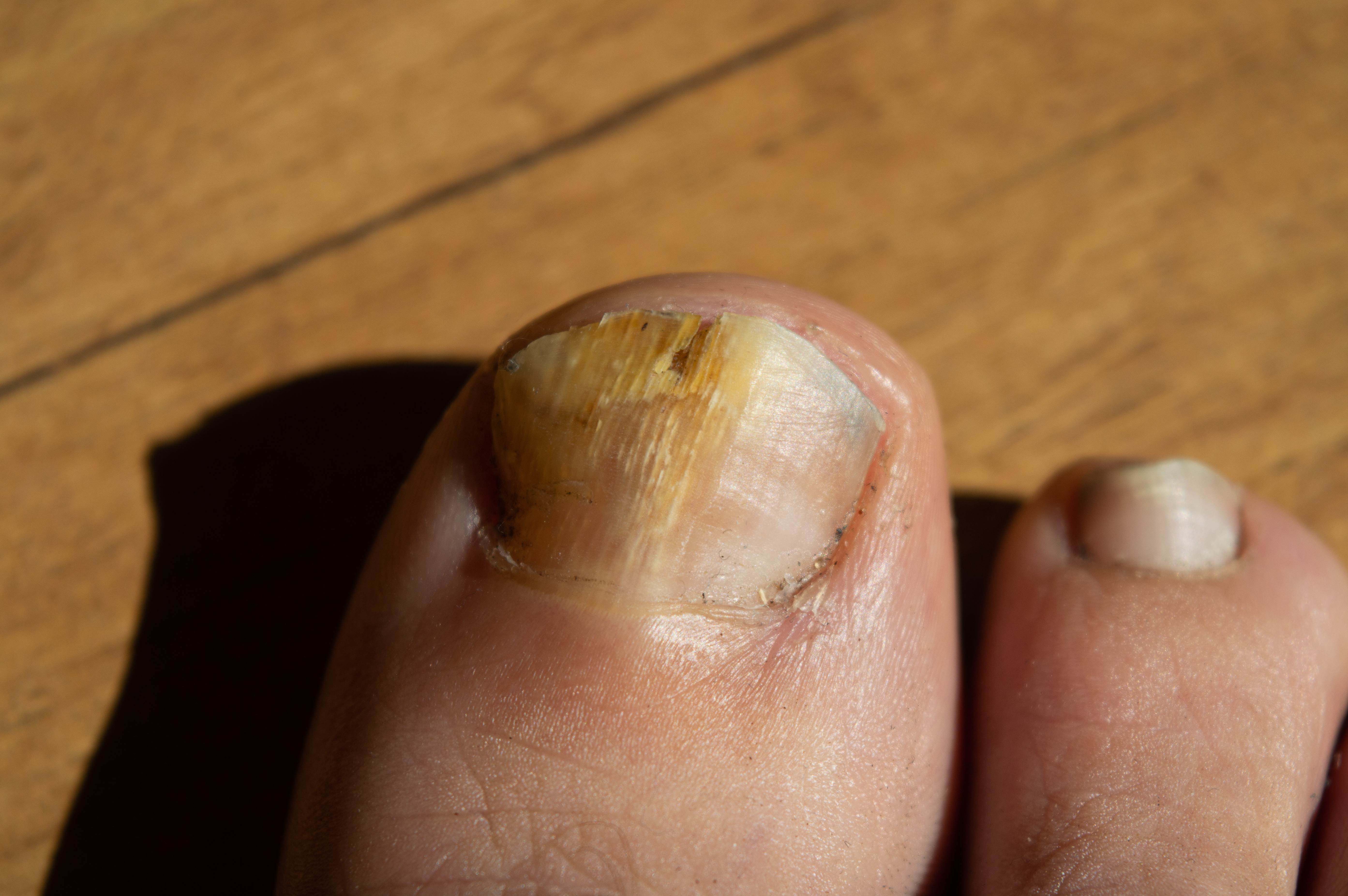 Fungal Toenails