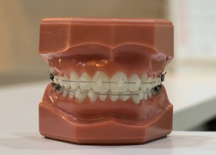 Metal Braces